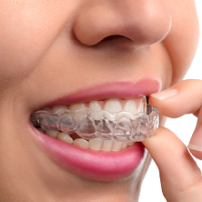 Treatments Braces Aligners