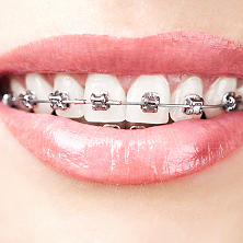 Treatments Braces Ligating