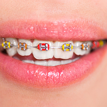 Treatments Braces Traditional